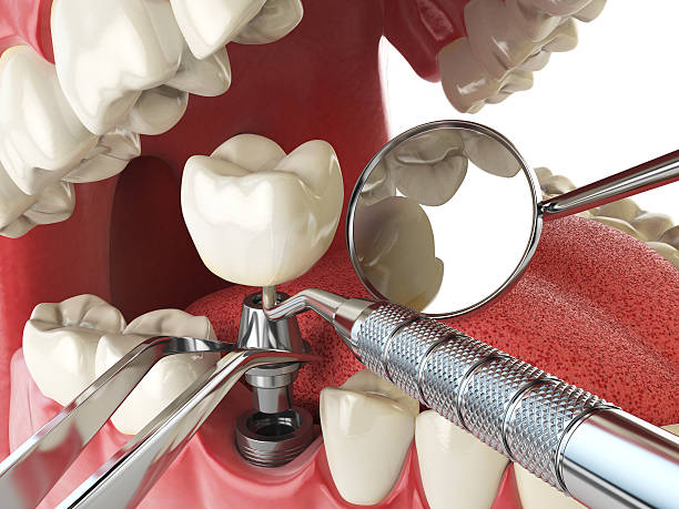 Best Emergency Dentist for Knocked-Out Tooth in Orting, WA
